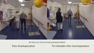 Hydrocefalus, f&ouml;re och efter shuntoperation