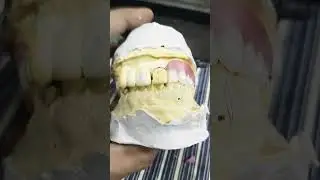 Upper Removable Partial Denture Ready for Flasking 😁😁😁#rpddentalprocedure #viralvideo#partialdenture