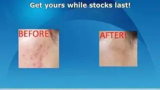 Derma Stamp for Acne Scarring