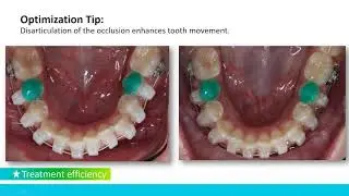 Engaging with Self-Ligation Achieving your goals with low force and light wires