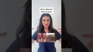 How to treat DARK Elbows & Knees | dermatology.doctor #shorts