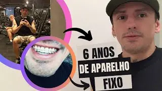 TIREI O APARELHO ORTODÔNTICO FIXO DEPOIS DE 6 ANOS USANDO 😳