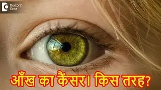 आपको कैसे पता चलेगा कि आपको आँख का कैंसर है? | Eye Cancer in Hindi- डॉ. सुनीता राणा अग्रवाल