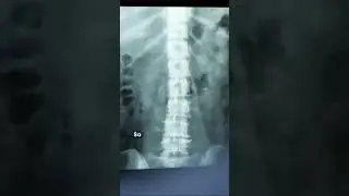 Why doctors ask to remove jewellery before X-ray? 💍🩻