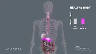 What is Diabetes?