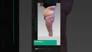 Vaser Liposuction of back and Fat Grafting To Buttocks | Moeinsurgicalarts | l #cosmeticsurgeon