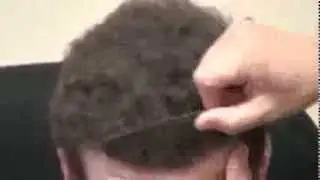 Hair Transplant Surgery Result Before After Norwood 6 Bald man Dr. Diep www.mhtaclinic.com