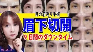 眉下切開9日間のダウンタイム＋おまけ【眼瞼下垂】
