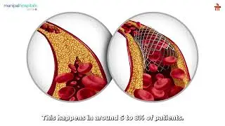 Laser Angioplasty for ISR &  Arteries | Dr. Keshava R | Manipal Hospital Old Airport Road