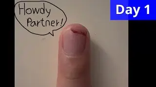 Finger nail recovery time lapse