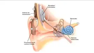 Donner du Sens au Son : de la surdité à l’implant cochléaire