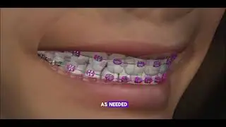 How Braces Are Placed: Step-by-Step Orthodontic Treatment