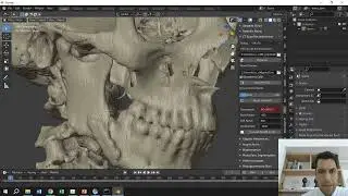 Andyara - Fratura de Mand&iacute;bula durante Exodontia- Tomografia de controle