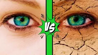 Dry Eye - Causes, Treatment, and Prevention