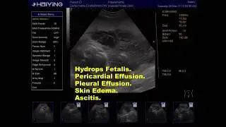 Ultrasound.Fetal Hydrops.edema.pl.effusion.percardial effusion.ascites.