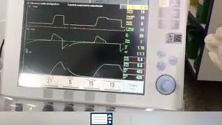 C&aacute;lculo de press&atilde;o plat&ocirc; e driving pressure em PCV no paciente Covid