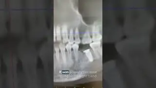 If you don't find a good dentist...this could happen. #shorts