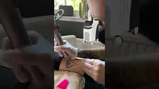 What can a picosure laser treatment CE Certification Piosure Machine