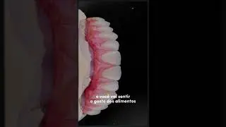 Odonto Couple destaca benef&iacute;cios da pr&oacute;tese fixa sobre implante para devolver sorrisos