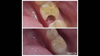 LIQUID CERAMICS FILLINGS - Doctor | Dentist | Swati Sanmukhani Makhija | Ahmedabad