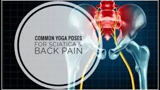 Relieve Sciatica and Back Pain with These Common Poses