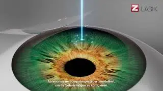 Z-LASIK - Fortschrittliche Sehkorrektur mit Niedrigenergie