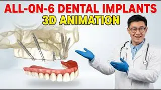 All on 6 Dental Implants 3D Animation &ndash; Full Mouth Solution