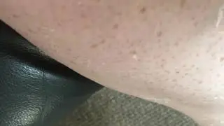 Peeling Sunburn Part 2