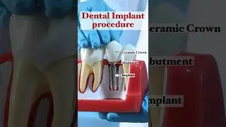 Dental Implant Procedure | ස්ථිර දතක් හිටවන විදිය 😯 #dentalimplants #sinhala #drduka