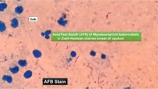 AFB Positive Slide of Mycobacterium tuberculosis