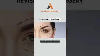 Revision Eye Surgery | Answer Plastic Surgery #shorts #revisioneyesurgery