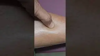 How to Check Pedal Edema #Edema #Swelling #Legswelling #pedaledema #clinicaldiagnosis #learnmedicine