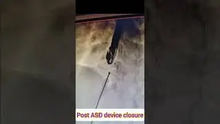 ASD device closure procedure,  