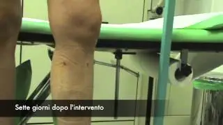 Ambulatorietà e scarsa invasività dell'intervento CHIVA , by veneinforma