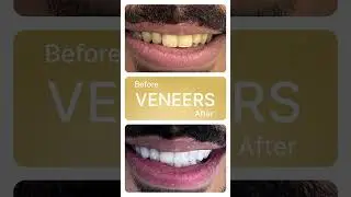 Veneers - Listen to what our expert cosmetic dentist Dr. Huda