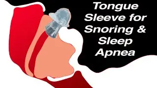 Tongue Suction Device (TSD) to Treat Snoring and Sleep Apnea