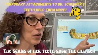 Dr. Scheurer&rsquo;s Own Scans- iTero/ Invisalign Journey- Sarasota Dentist