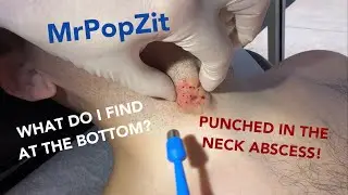 I punch a deep hole to the core of this abscess! You can see what caused it! See it clearly! Amazing