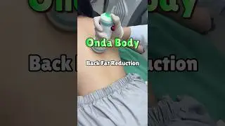 Non-Surgical Back Sculpting: My Onda Body Coolwaves Experience！ #skinclinic #koreanskincare #onda