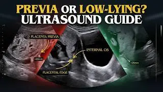 Placenta Previa vs Low Lying on Ultrasound: Previa, Vasa Previa & Cord Insertion in 10 Minutes