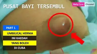 Petua Pusat Bayi Tersembul | Belly Button Hernia | PART 1 |