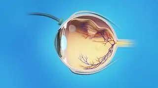Retina desprendida: Vitrectomía