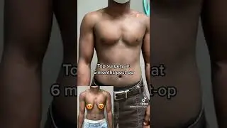 Top surgery at 6 months post-op #ftm #pridemonth #topsurgery