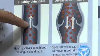 Venous Insufficiency