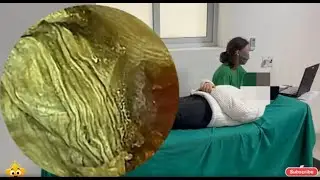 采耳哥 | Giant Earwax Blockage | Disturbing but Satisfying Removal #BM298