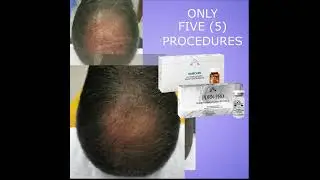 Only 5 procedures for hair repair