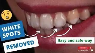 How to remove white spot on teeth | smile makeover | smile designing |your dentist #dentistry #viral