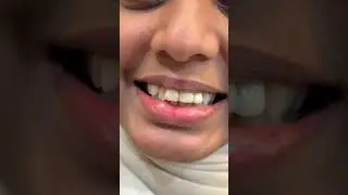Awesome smile correction with in 3days #dentist #smiledesigndental #dentalprosthesis