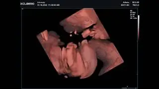 3D Pretecho 23 Weken