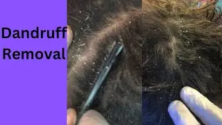Dandruff Removal - medium